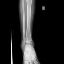 Torsion fracture) is a bone fracture occurring when torque (a rotating force) is applied along the axis of a bone. Spiral Fracture Tibia Radiology Case Radiopaedia Org