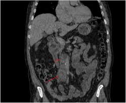 Maybe you would like to learn more about one of these? Malignant Mesothelioma Of The Tunica Vaginalis Testis A Rare Case And Review Of Literature Bmc Cancer Full Text
