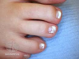 Image result for onychomycosis