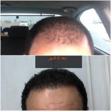 تكلفة ومراكز زراعة الشعر في الاسكندرية بشرة وشعر
