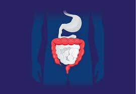 How colon cancer is diagnosed? Bowel Cancer Colon Cancer Causes Symptoms And Treatment
