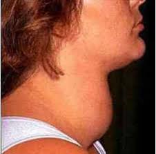 Seen in mountainous areas around the world and various other regions … Node Of The Thyroid Code On The Icd 10 Nodal Goble Diffuse Endemic Goiter