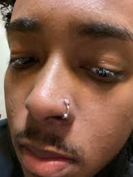 Piercing guns aren't strong enough to properly pierce your nostril. I Started To Clean My Nose Piercing More After The Infection Happened Now I Have This What Do I Do Legitpiercing