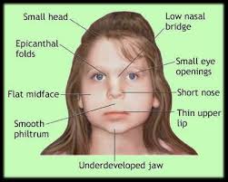 And medial epicanthal folds, a flat nasal bridge, macroglossia, a single transverse palmar crease on the left hand, as well as bilateral. Developmental Pathology Flashcards Memorang