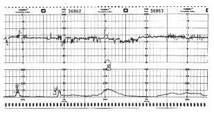 Image result for Non-Stress Test