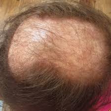 However, when the behavior stops, hair occasionally grows back gray or white and it may be finer, coarser or curlier. Trichotillomania Permanent Damage Gallery Lucinda Ellery Consultancy Uk