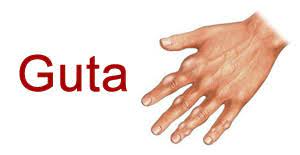 Tratamentul accesului gutos se face cu 2. Despre Guta Si Dieta Sa Tratament Naturisttratament Naturist