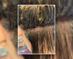 Tea tree oil's insecticidal properties help to kill both, lice and their eggs i.e. Try These Easy Home Remedies To Get Rid Of Lice Eggs