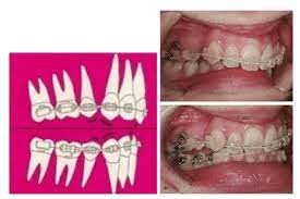 Jadi, behel gigi jenis ini sangat cocok untuk kamu yang merasa kurang percaya diri menggunakan kawat gigi. Power Chain Di Seluruh Gigi Yes Or No Jb Dental Klinik