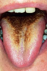 Image result for black tongue symptoms
