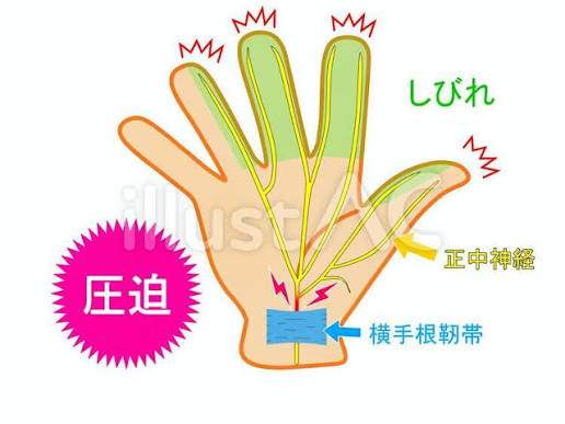 手根管症候群イラスト - No: 1321380｜無料イラスト・フリー素材なら「イラストAC」