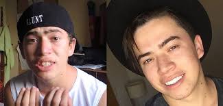 Vantagens do dente de porcelana antes é depois. Febre Dos Famosos Saiba Tudo Sobre Faceta E Lente De Contato Para Os Dentes Jornal Correio