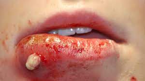 We did not find results for: Mrsa Staph Infection Pictures Symptoms Treatment And Prevention