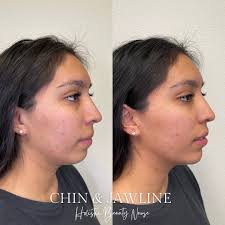 Facial balancing is so important. I love how she trusted me to give her  more chin projection and sharpen the jawline to bring her beautiful facial  features into balance. The chin is