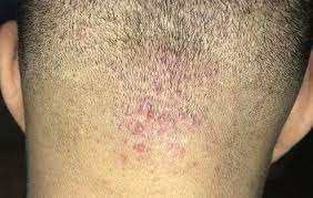 التهابات الجريبات أسبابها مجلة اسال طبيبك