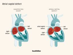Image result for Atrial Septal Defect