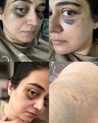 This is a day to day visual representation of the recovery of the Abuse I have seen. I take this opportunity to thank everyone who has supported me shown concerns about my