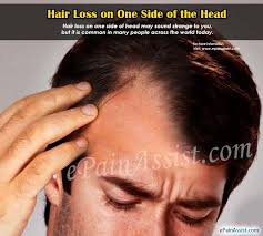 Taking large amounts of vitamin a or selenium is also toxic and can cause hair loss. Hair Loss On One Side Of The Head Causes Treatment Diagnosis