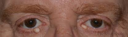 Image result for milium cyst on eyelid