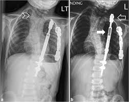 Serial lengthening of VEPTR (rib-to-spine and left rib-to-rib) in a... | Download Scientific Diagram