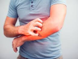 Akan tetapi penggunaan salep pada tubuh sebaiknya sesuai anjuran dokter untuk mendapatkan dosis yang tepat. 7 Bahan Alami Untuk Mengatasi Kulit Gatal Akibat Alergi Hot Liputan6 Com