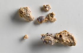 5 Kidney Stone Symptoms To Watch Out For Foryourkidney Calculos Renales Artritis En Las Manos Artritis