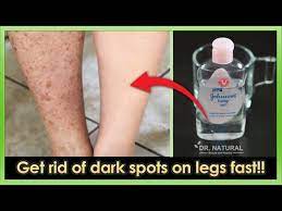 Walmart.com has been visited by 1m+ users in the past month How To Get Rid Of Dark Spots Scar Mosquito Bites Hyperpigmentation On Legs Fast Youtube
