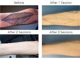 Bbb directory of tattoo removal near las vegas, nv. Remove Henna Tattoo Faster Oktober 2017