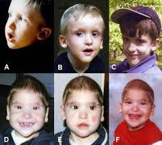 In this case, this is a new gene mutation which occurs during the. Mowat Wilson Syndrome Clinical Features Of Patients 3 And 4 At Age Download Scientific Diagram