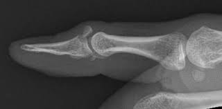 Mallet finger is a condition in which the tendon in the outermost joint of a finger is ripped, causing the tip of the finger to droop. Mallet Finger Litfl Trauma Library