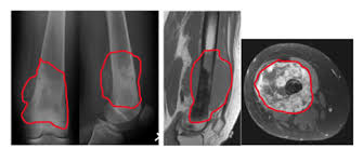 Image result for Osteosarcoma