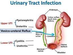 Urinary Tract Infection Dr Kisa Denis Twinokwesiga Facebook