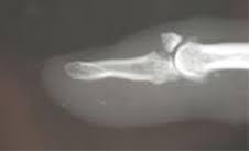 Alibaba.com offers 1,194 finger mallet splint products. Mallet Finger Hand Orthobullets