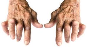 Lorsqu'on commence à gratter, la friction de la peau du pouce et des doigts sur les cordes peut provoquer une sensation de chaleur éviter de ronger vos ongles et de manger la peau autour des doigts et avoir une hygiène ongle et mains correcte vous évitera pas mal de petits soucis. Polyarthrite Rhumatoide Symptomes Et Traitement Doctissimo