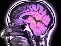 It can lead to weakness and paralysis that may last for months or years. Some Covid 19 Patients Stricken By Guillain Barre Syndrome