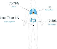Adenocarcinoma cancers being usually in one of the following organs: Mesothelioma Facts Statistics For 2021