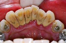 Maybe you would like to learn more about one of these? Cara Mudah Hilangkan Karang Gigi Dengan Menggunakan Garam Dan Baking Soda Karang Gigi Terus Hilang Kartel Dakwah