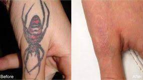 Depending on the size of the tattoo, surgical removal may range between $150 and $350, according to st. Houston S Premium Laser Tattoo Removal Clinic Advanced Technology