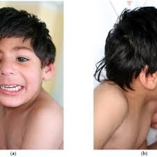 Facial features of our patient at 4 years 7 months of age: (a) front,...