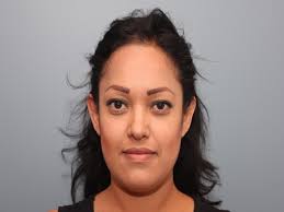 Ear Surgery Before and After Photos by Larry Nichter, MD; Newport Beach, CA 