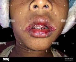 Image result for Angular Stomatitis