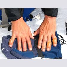 Image result for Frostbite