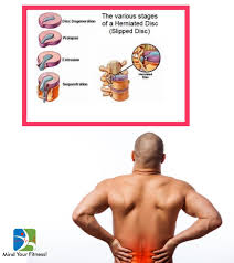 Unfortunately, injuring your spinal discs can be a painful and confusing experience. Slipped Disc Is It Okay To Lift Weights Mind Your Fitness