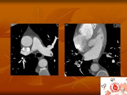 La diagnosi è molto affidabile. Embolia Polmonare Acuta Angio Tc Ppt Scaricare