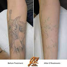 Soft Grey Wash With Little To No Line Work Is Almost Always Fast To Fade Evident In This Progress Photo After Just 3 Tattoos Laser Tattoo Removal Laser Tattoo