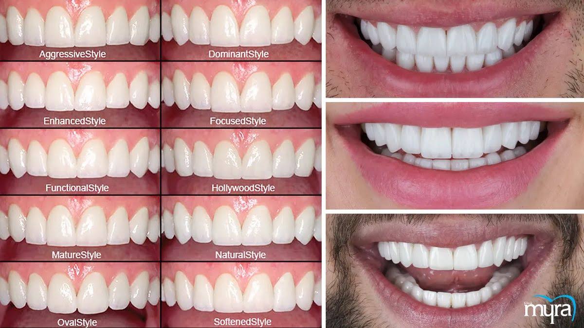 Dental Veneers Treatment in Sus, Pune product image
