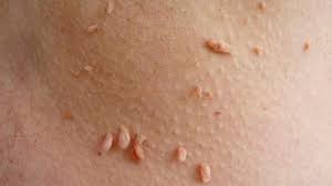 Image result for verrucae filiformes