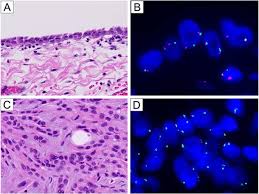 Histopathology of mesothelioma cells provide various insight to the illness and is a methods of accurate diagnosis. Hemizygous Loss Of Nf2 Detected By Fluorescence In Situ Hybridization Is Useful For The Diagnosis Of Malignant Pleural Mesothelioma Modern Pathology