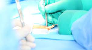 اعراض الفتق وأنواعه وعلاجاته تعرف عليها ويب طب
