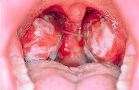 La mononucleosi è una malattia infettiva che si trasmette attraverso la saliva; Mononucleosi Quali Sono I Sintomi Cause E Le Complicazioni